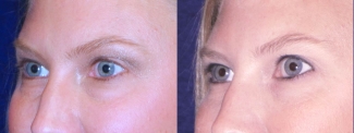 Left 3/4 View - Transconjunctival Eyelid Surgery