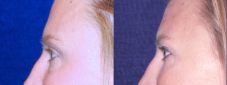 Left Profile View - Transconjunctival Eyelid Surgery