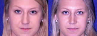 Frontal View - Rhinoplasty