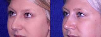 Left 3/4 View - Rhinoplasty