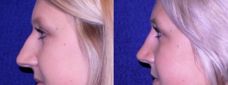 Left Profile View - Rhinoplasty