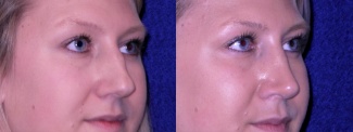 Right 3/4 View - Rhinoplasty