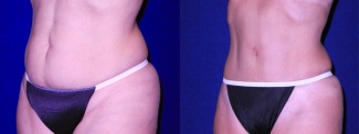 Left 3/4 View - Tummy Tuck and Liposuction