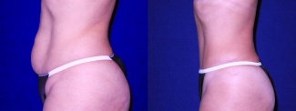 Left Profile View - Tummy Tuck and Liposuction