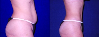 Right Profile View - Tummy Tuck and Liposuction