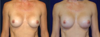 Frontal View - Breast Implant Revision - Silicone Implants