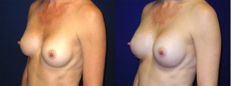 Left 3/4 View - Breast Implant Revision - Silicone Implants