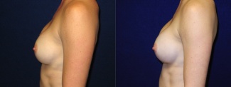Left Profile View - Breast Implant Revision - Silicone Implants