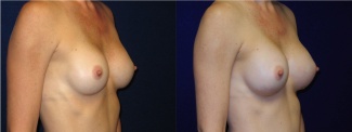 Right 3/4 View - Breast Implant Revision - Silicone Implants