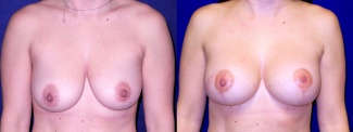 Frontal View - Breast Augmentation with Lift