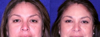 Frontal View Close Up - Upper Blepharoplasty