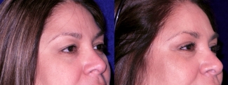 Right 3/4 View Close Up - Upper Blepharoplasty