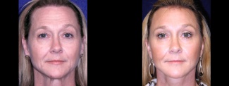 Frontal View - Facelft, Browlift and Upper Eyelid Surgery