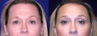 Frontal View Close Up - Facelft, Browlift and Upper Eyelid Surgery