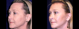 Left 3/4 View - Facelft, Browlift and Upper Eyelid Surgery