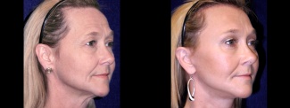 Left 3/4 View - Facelft, Browlift and Upper Eyelid Surgery