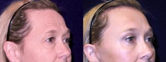 Left 3/4 View Close Up - Facelft, Browlift and Upper Eyelid Surgery