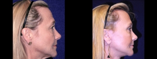 Right Profile View - Facelft, Browlift and Upper Eyelid Surgery
