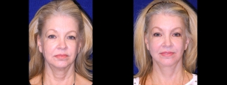 Frontal View - Facelft, Browlift and Upper Eyelid Surgery