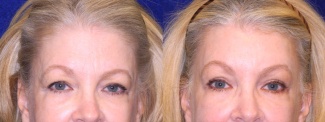 Frontal View Close Up - Facelft, Browlift and Upper Eyelid Surgery