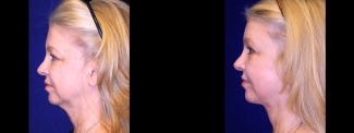 Left Profile View - Facelft, Browlift and Upper Eyelid Surgery