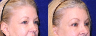 Right 3/4 View Close Up - Facelft, Browlift and Upper Eyelid Surgery