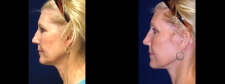 Left Profile View - Facelft and Browlift