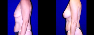 Left Profile View - Breast Augmentation & Tummy Tuck
