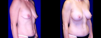 Right 3/4 View - Breast Augmentation & Tummy Tuck