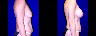 Right Profile View - Breast Augmentation & Tummy Tuck