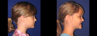 Right Profile View - Otoplasty