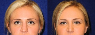 Frontal View - Rhinoplasty