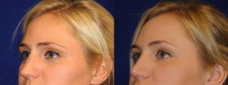 Left 3/4 View - Rhinoplasty