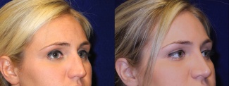 Right 3/4 View - Rhinoplasty