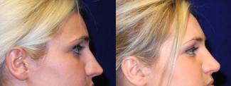 Right Profile View - Rhinoplasty