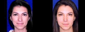 Frontal View - Rhinoplasty