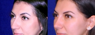 Left 3/4 View - Rhinoplasty