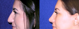 Left Profile View - Rhinoplasty