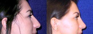 Right Profile View - Rhinoplasty