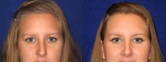 Frontal View - Rhinoplasty