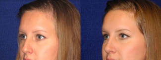 Left 3/4 View - Rhinoplasty