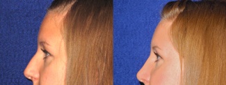 Left Profile View - Rhinoplasty