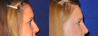 Right Profile View - Rhinoplasty