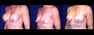 Left 3/4 View - Implant Revision - Contracted Saline, Deflated, Replaced with Silicone Implants