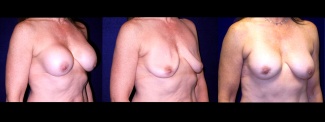 Right 3/4 View - Implant Revision - Contracted Saline, Deflated, Replaced with Silicone Implants