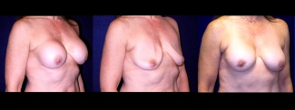 Right 3/4 View - Implant Revision - Contracted Saline, Deflated, Replaced with Silicone Implants