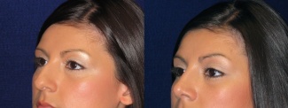Left 3/4 View - Rhinoplatsy