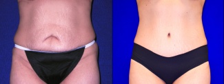 Frontal View - Tummy Tuck