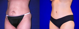 Left 3/4 View - Tummy Tuck