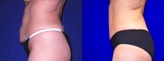 Left Profile View - Tummy Tuck